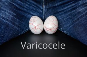 varicocele